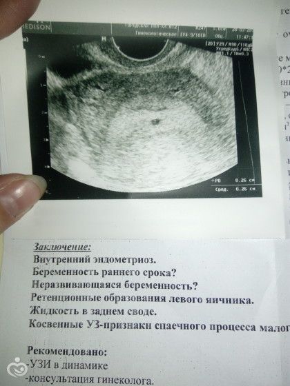 Когда можно увидеть беременность. УЗИ беременности 5 недель эндометрий. УЗИ на 5 неделе беременности от зачатия. УЗИ внематочной беременности 3 недели. УЗИ 2 недели беременности.