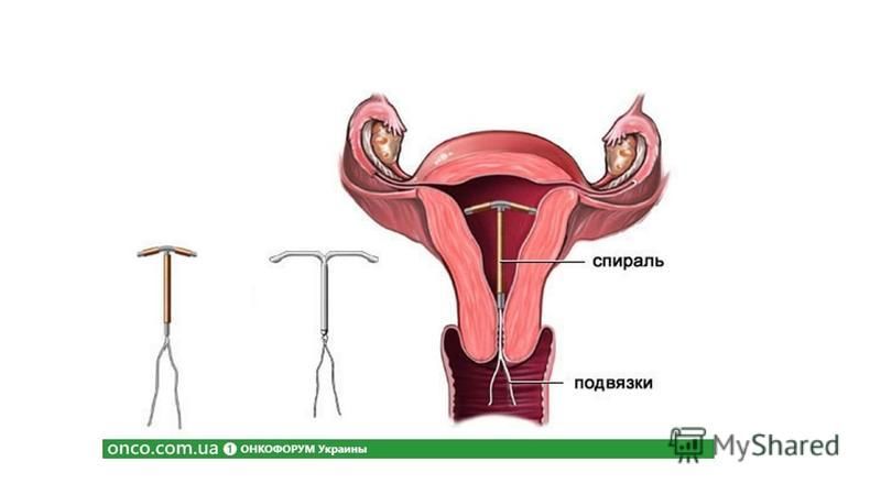 После введение спирали. Гормональная внутриматочная спираль.