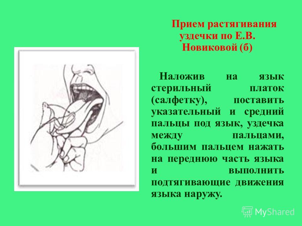 Связка языка. Растяжка уздечки языка. Подрезать уздечку языка ребенку. Растягиваем уздечку языка. Растягиваем уздечку языка ребенку.