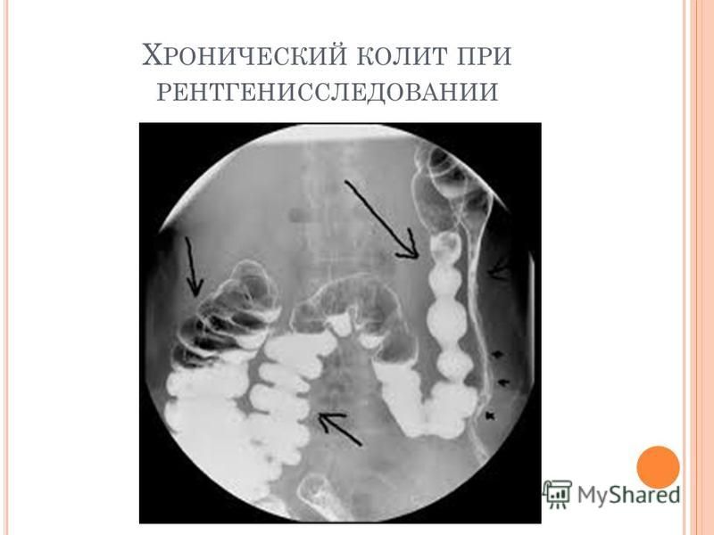 Колет или колит