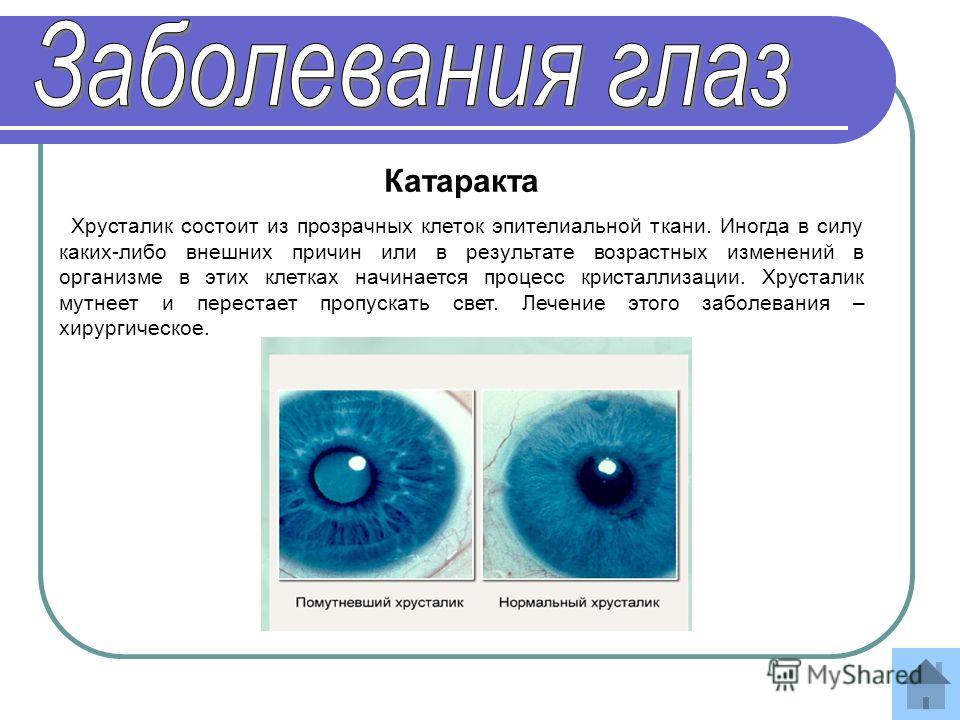 5 заболеваний глаз. Заболевания глаз доклад. Сообщение по биологии о заболеваниях глаз. Краткое сообщение о заболевании глаз. Глазные заболевания сообщение 8 класс.