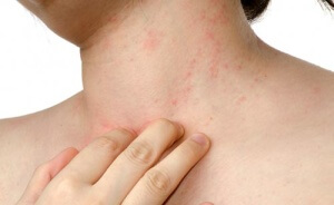 Аллергия на шее причины