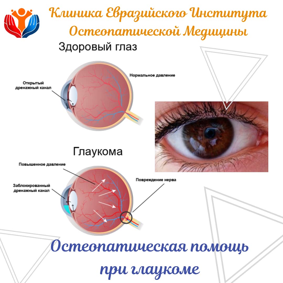 Глаукома лечение у взрослых