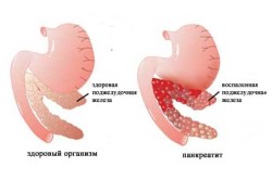Схема панкреатита