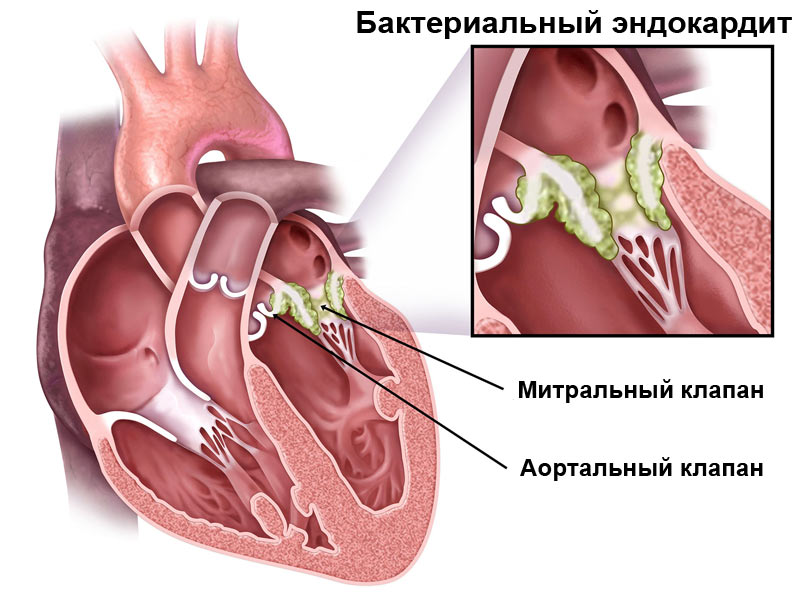 Воспаления на аортальном и митральном клапанах