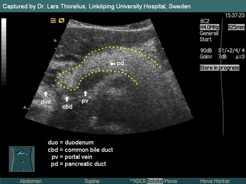 на узи снимке видна область повышенной эхогенности (белее, чем другие части изображения) - поджелудочная железа, пораженная липоматозом
