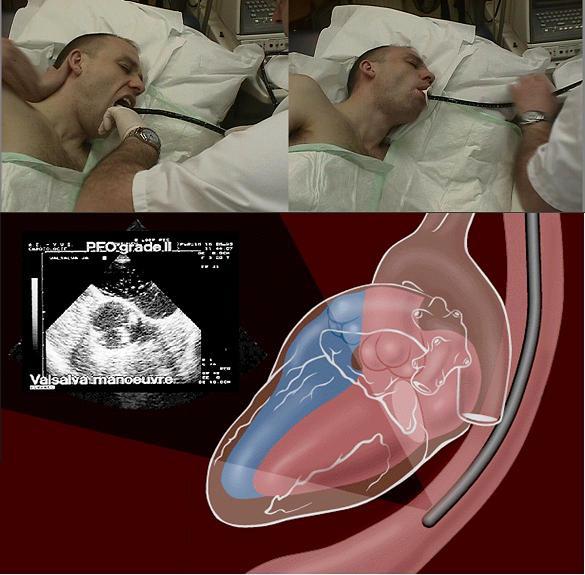 Мужчине проводят транспищеводную эхокардиографию