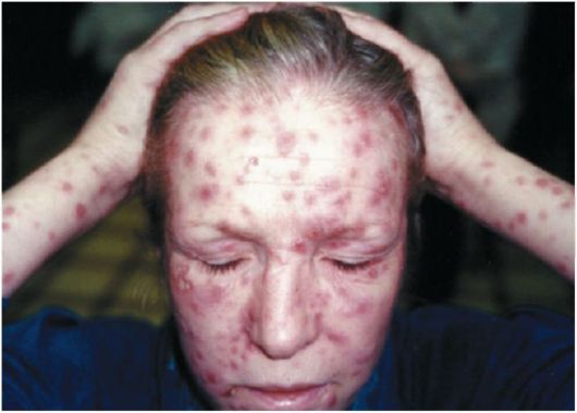  признаки вторичного сифилиса на лице 