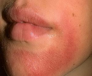 Лечение аллергии на лице у взрослых