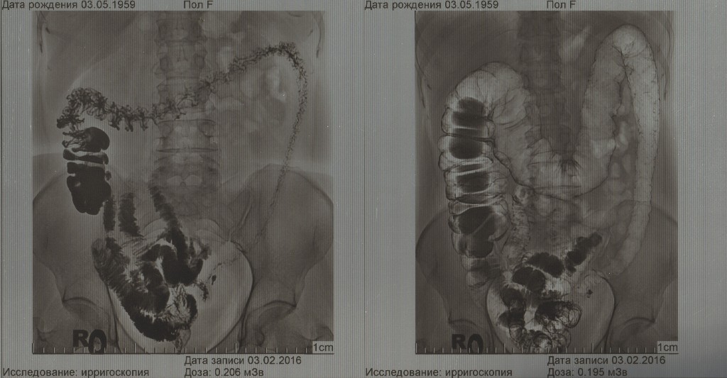 Сильно болит задний проход. Что слева в животе. Болит в левой нижней части живота. Болит матка с левой стороны. Опухоль в нижней левой части живота.