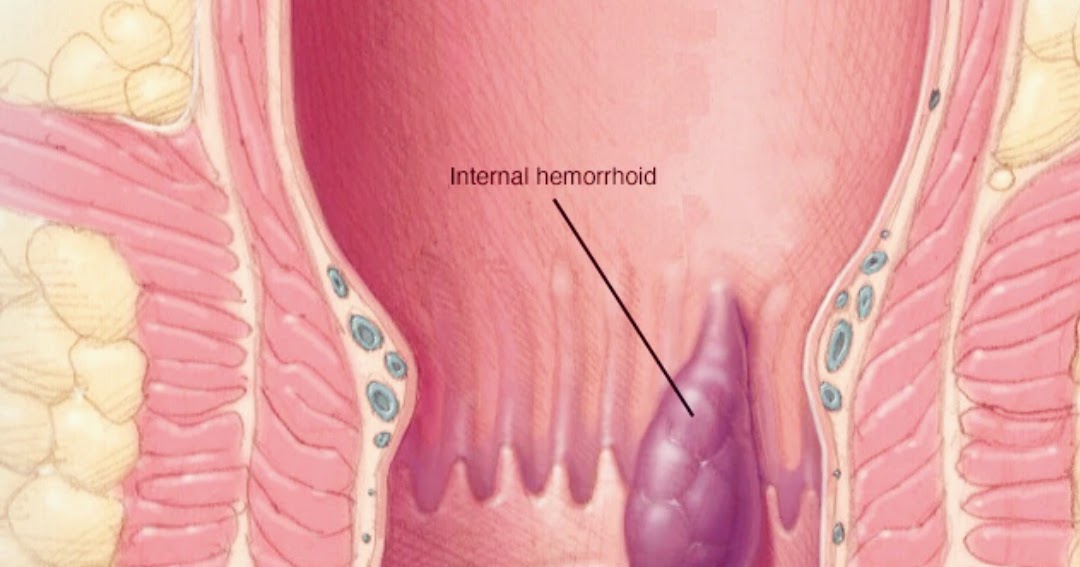 После дефекации жжение в заднем. Внутренние геморроидальные узлы.