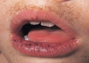 Гиперпигментация на нижней губе