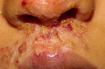 Стафилококковая инфекция носа