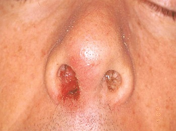 Стафилококковая инфекция в преддверии носа