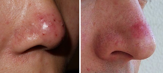 akne pyatna nosa - Черные пятна на носу у человека