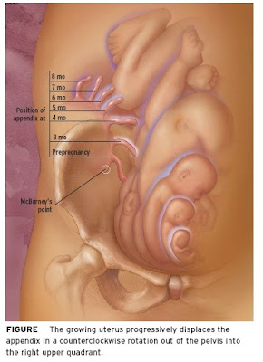 Appendicitis In Pregnancy Symptoms: Appendicitis And Pregnancy