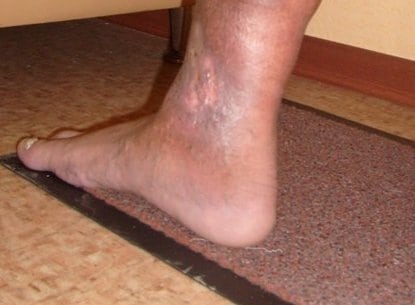 Трофическая язва на ноге при сахарном диабете: лечение болячки инсулином, фото нижних конечностей