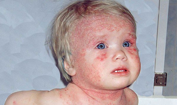 аллергия на голове у детей