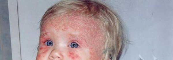 аллергия на лбу у ребенка