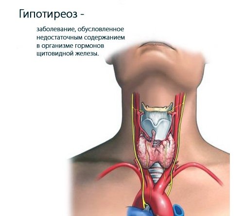 Причиной может быть гипотириоз и другие гормональные нарушения