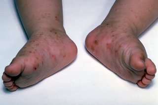 Scabies rash on a baby