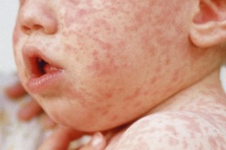Measles rash on a child