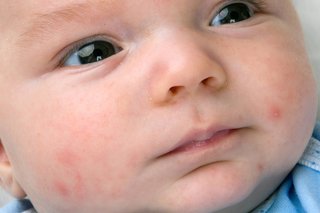 Acne on a baby