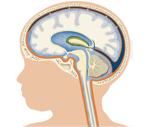 Смешанная гидроцефалия головного мозга у детей