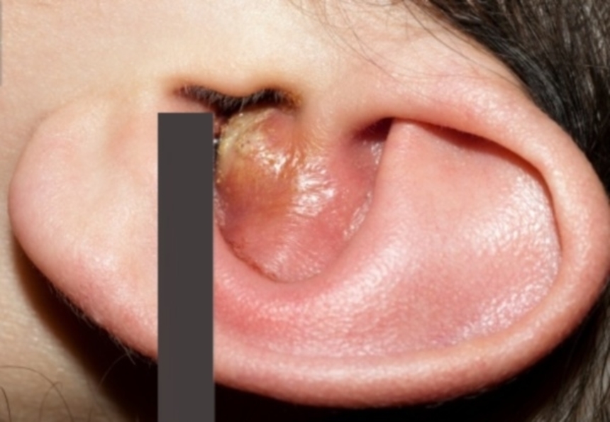 Симптомы и разновидности фурункула: фурункул в ухе