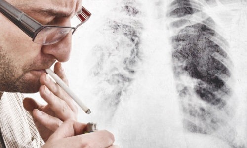 Первичная опухоль легких развивается у курильщиков старше 40 лет