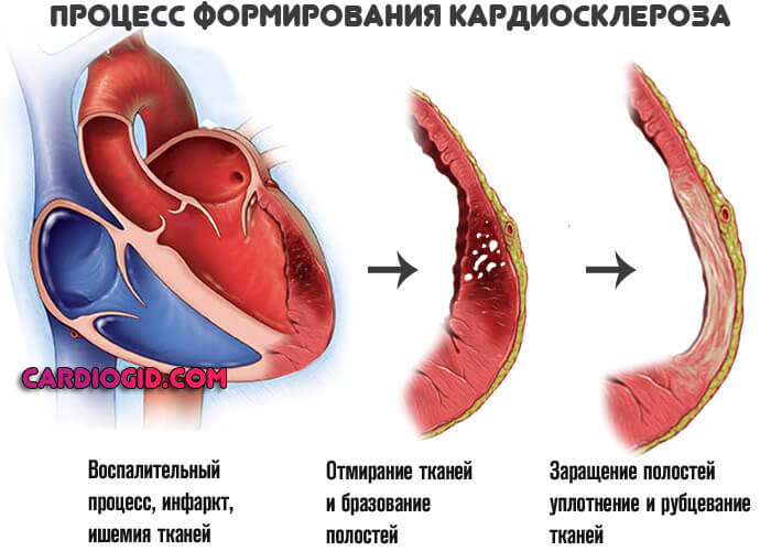 кардиосклероз