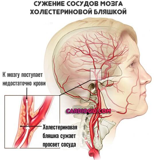 сужение сосудов мозга в результате атеросклероза