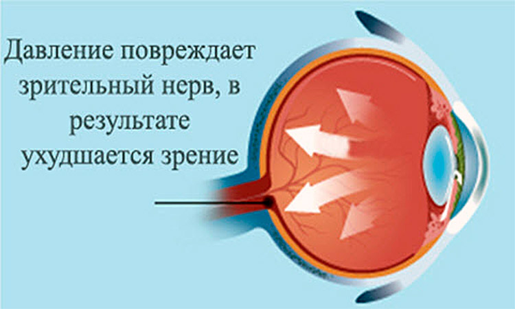 Признаки глазного давления. Повышенное внутриглазное давление симптомы. Глазное давление симптомы у взрослых. Давление глазного яблока. Повышенное давление глазного дна.