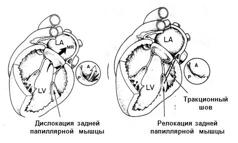 Техника транслокации задней папиллярной мышцы