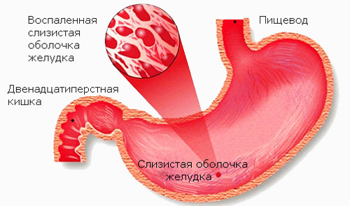 воспаление слизистой оболочки желудка при гастрите