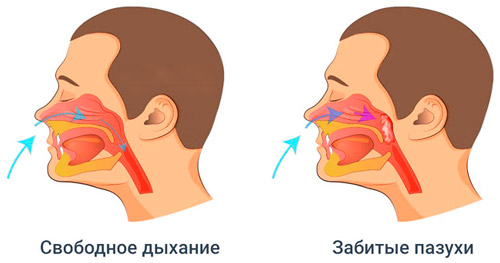 чистыке носовые пазухи и заложенность носа