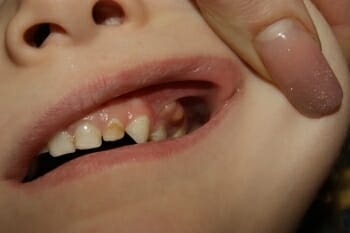 Причины воспаления десны около зуба, лечение в домашних условиях