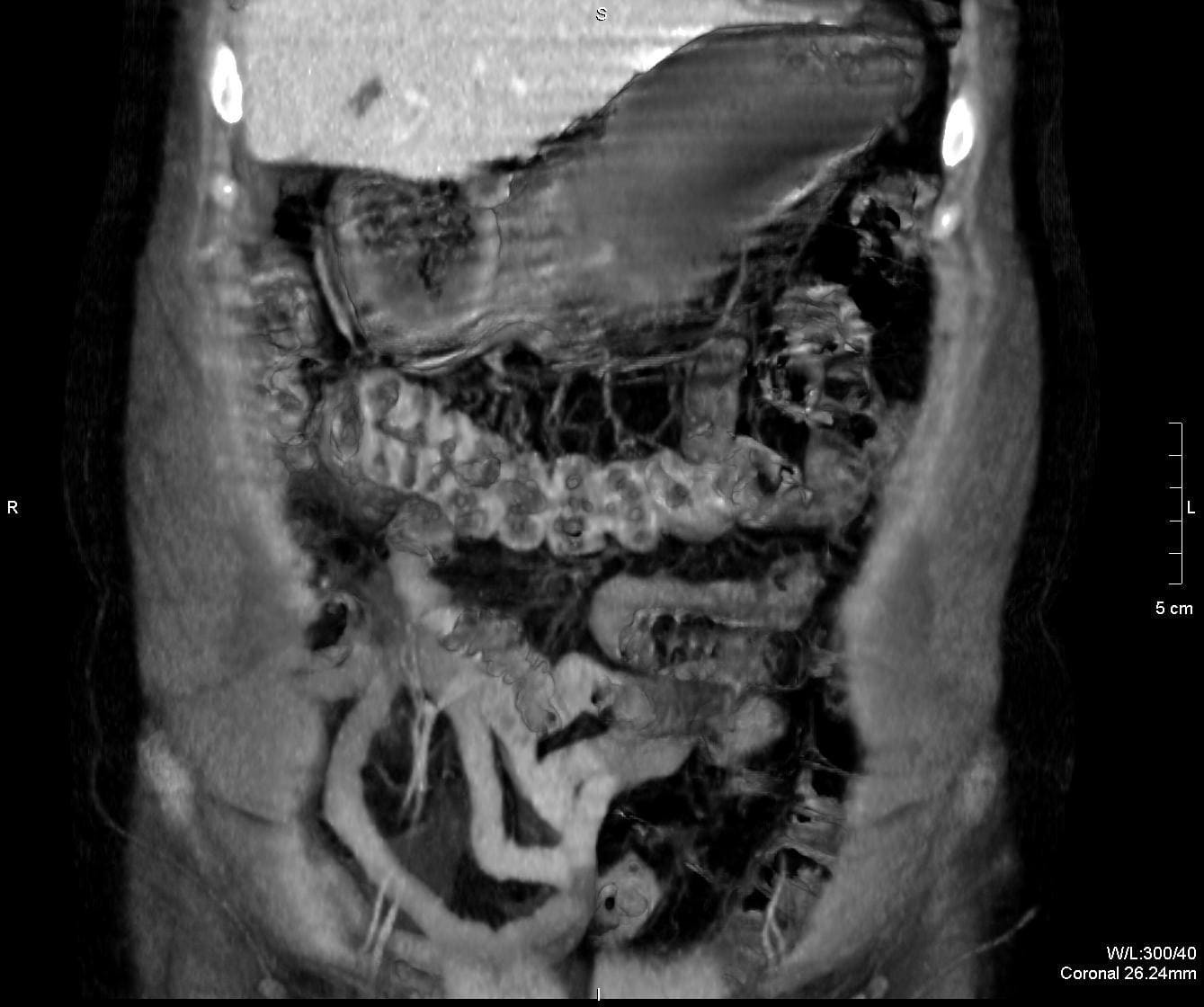 Компьютерная томография брюшной полости фото