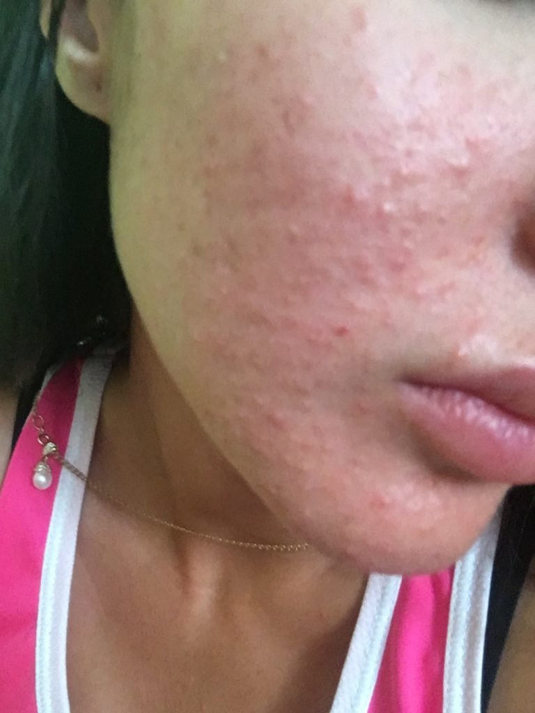 Аллергия на лице: фото, чем лечить на щеках прыщи