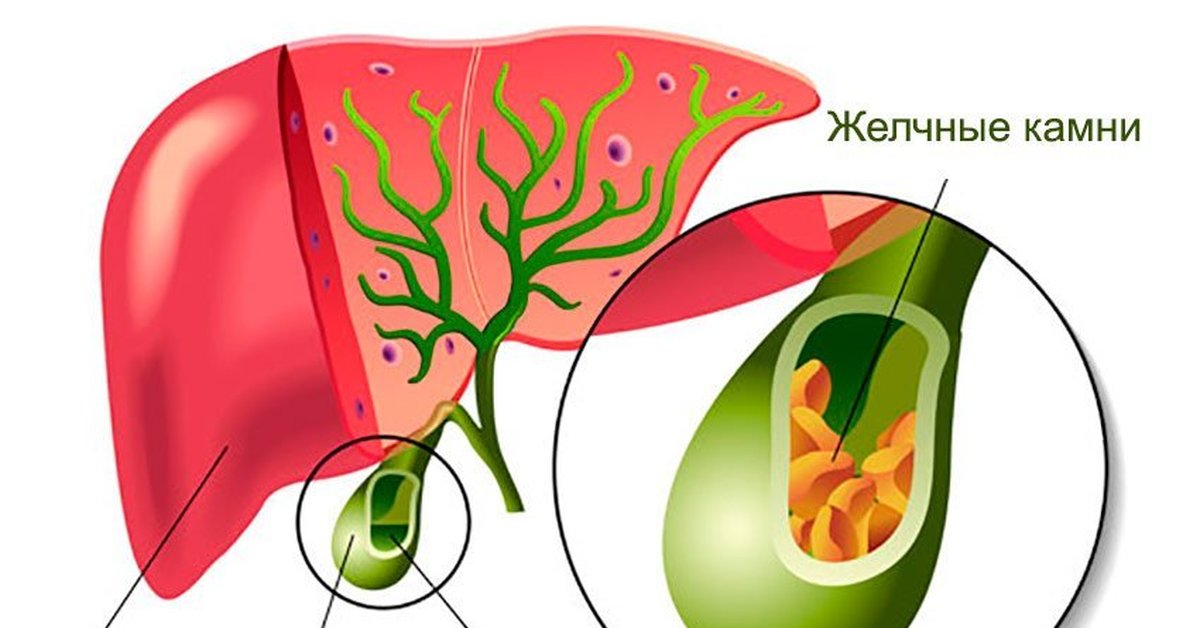 Желчекаменная болезнь картинки для презентации