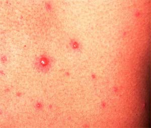 chickenpox vesicle on adult