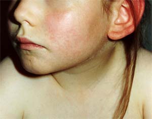 mild example of fifth disease rash