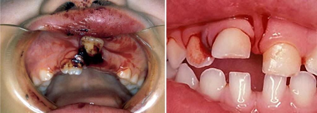 На фото показана подвижность зуба при ушибе