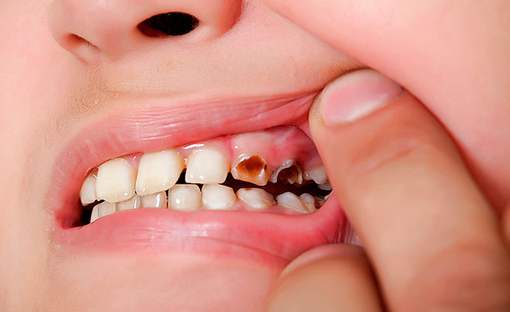 Кариес может быть причиной подвижности зуба