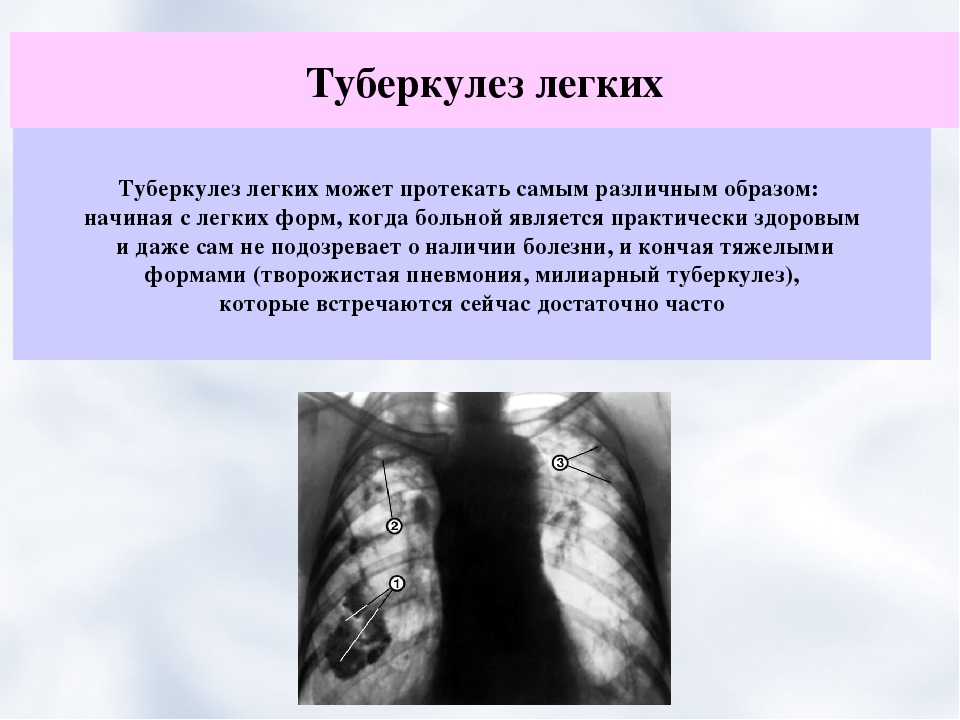 Причины туберкулеза. Как лечится туберкулез. Вылечить туберкулез легких.