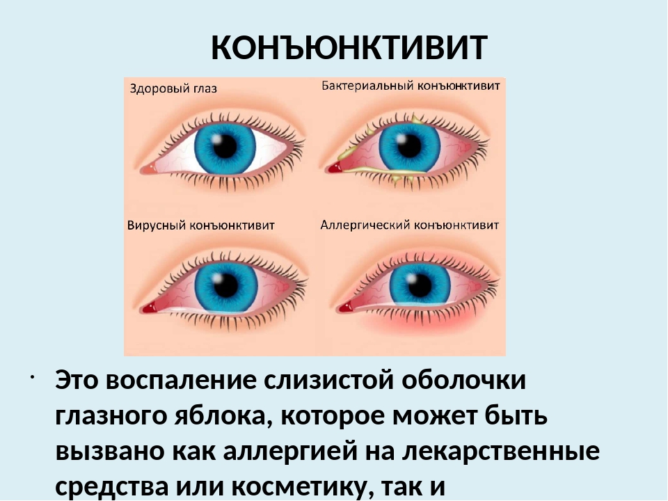 Назовите причины конъюнктивита какую помощь надо оказать. Болезнь глаз конъюнктивит. Предупреждение заболеваний глаз. Профилактика болезней глаз.