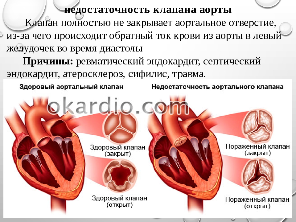 Поражение митрального клапана. Порок аортального клапана сердца. Клапан аорты порок сердца. Недостаточность аортального клапана +2. Врожденный двустворчатый аортальный клапан.