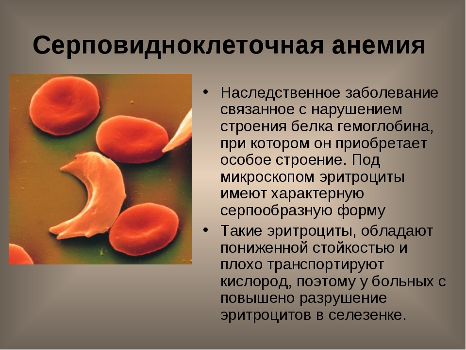 Анемия и эритроциты в крови. HBS серповидноклеточная анемия. Гемолитические анемии серповидноклеточная анемия. Серповидноклеточная анемия строение гемоглобина. Структура гемоглобина при серповидноклеточной анемии.