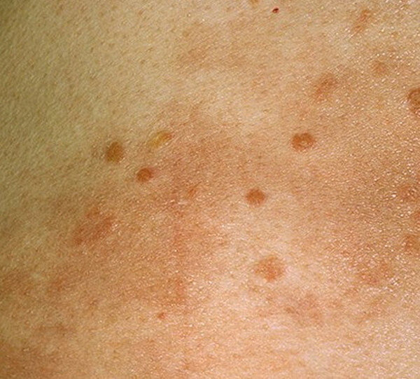hiv rash photo