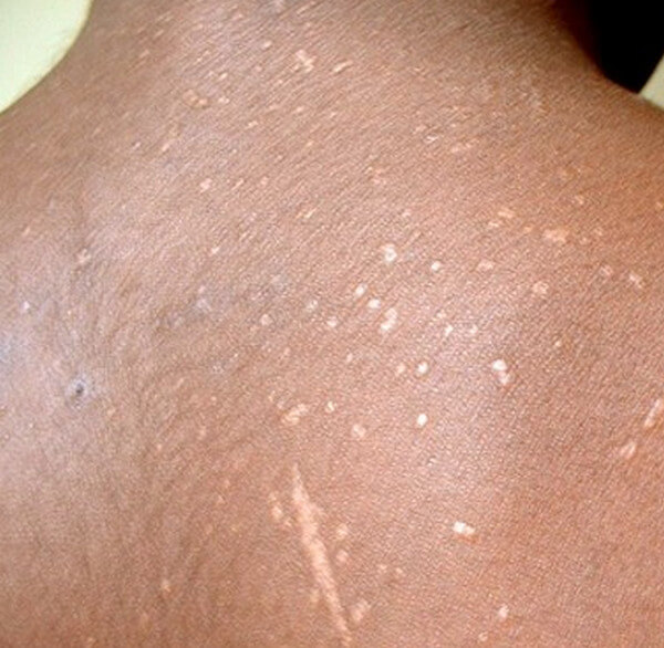 hiv rashes pictures